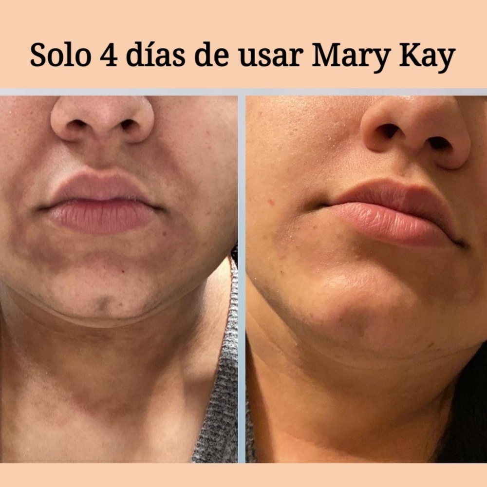 TimeWise® Microdermabrasion Plus